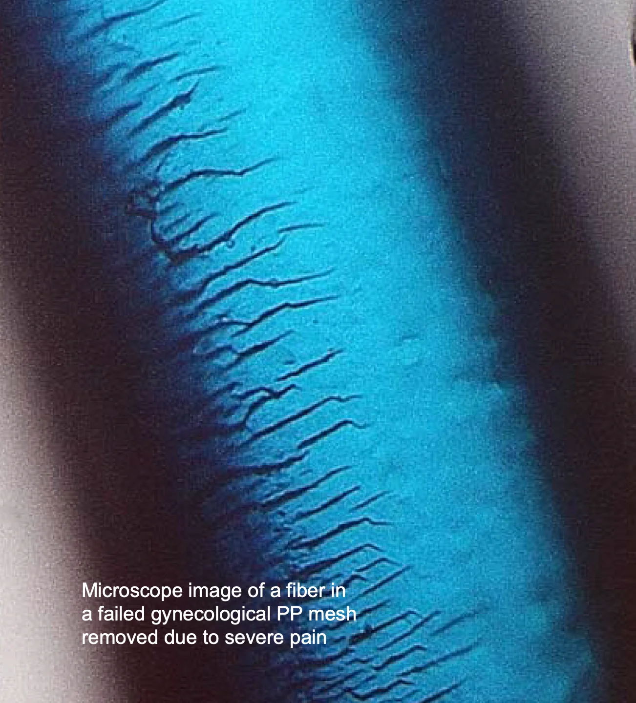 Microscope image of degraded polypropylene mesh fiber showing crack propagation from forensic failure analysis