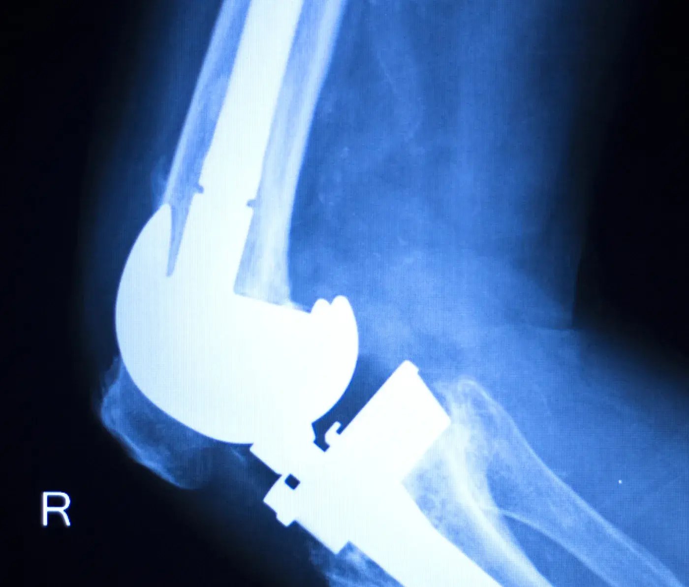 X-ray of total knee replacement implant with UHMWPE polyethylene component for orthopedic failure analysis