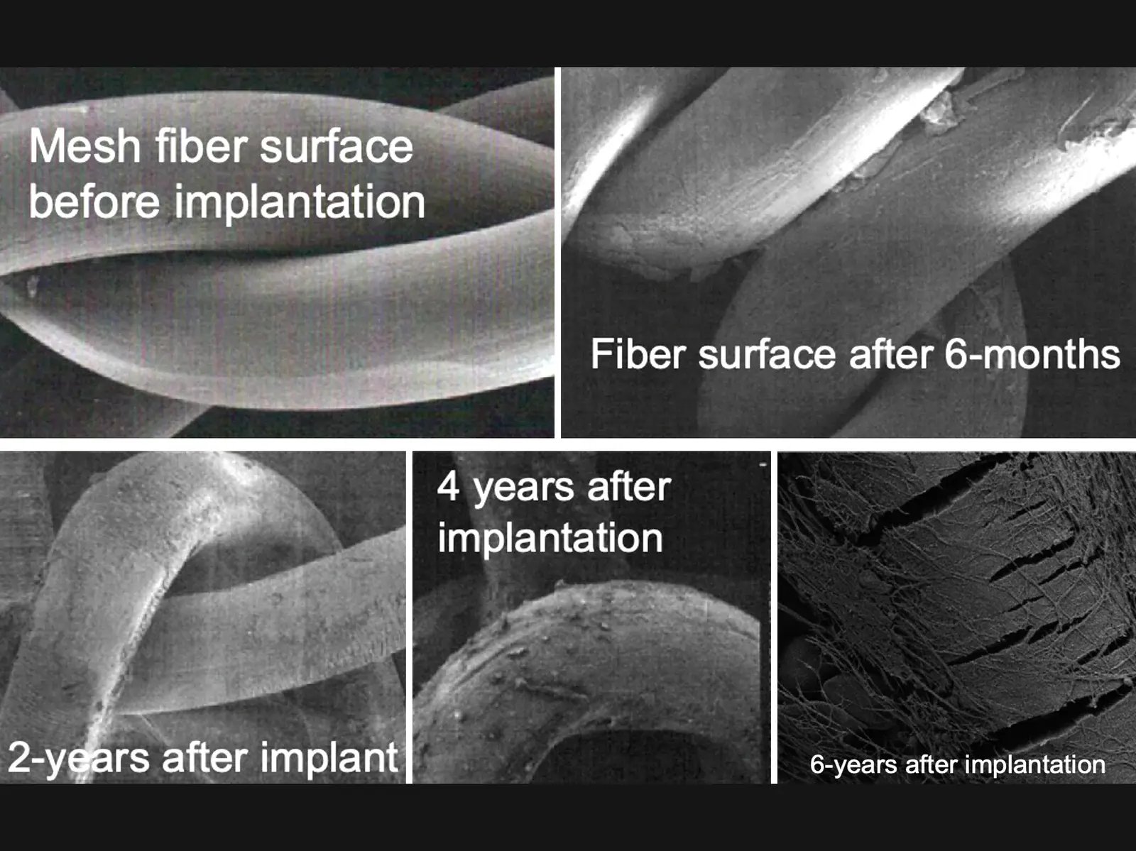 SEM comparison of PP mesh fiber degradation over time from implantation to 6 years showing progressive embrittlement